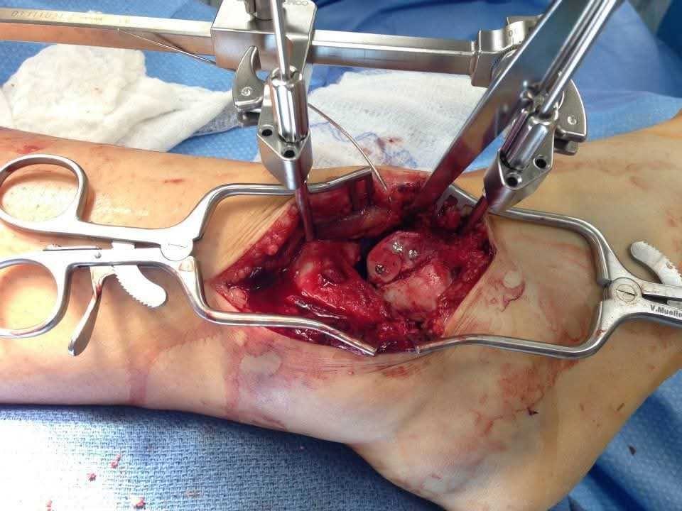 Sierra's ankle after surgery