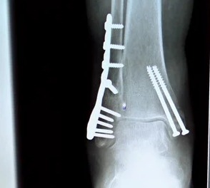 Illustrative X-ray: ankle repaired with a plate and screws
